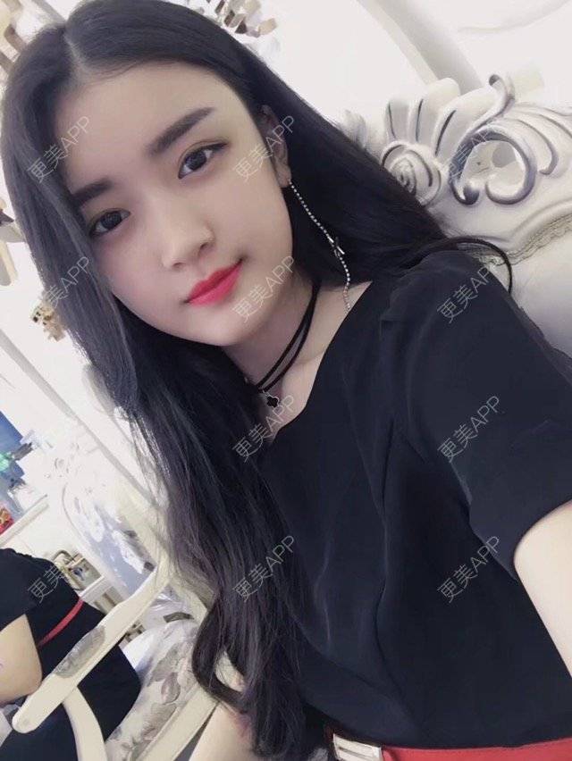 更美 - 石头玛丽的自体脂肪丰苹果肌经验 | 视频日记 | 成都