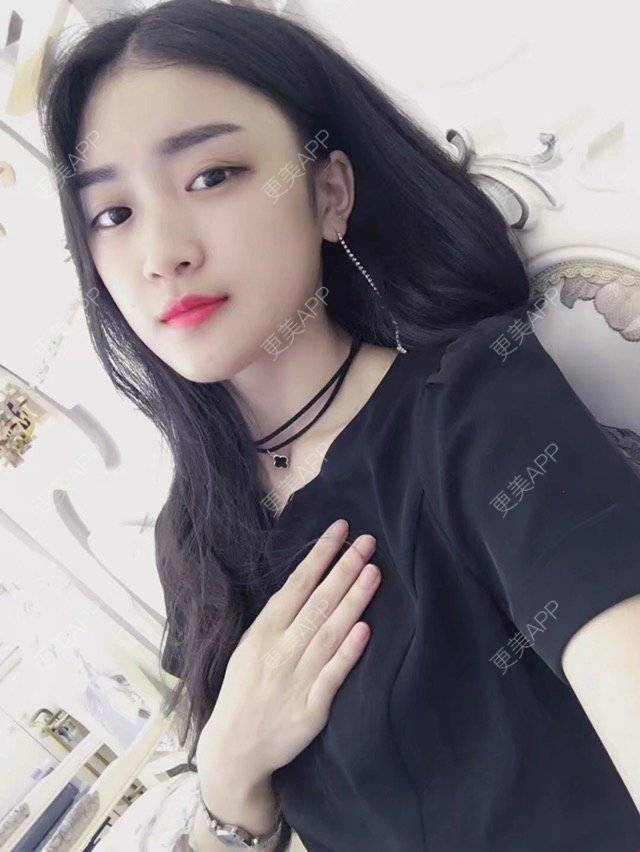 更美 - 石头玛丽的自体脂肪丰苹果肌经验 | 视频日记 | 成都