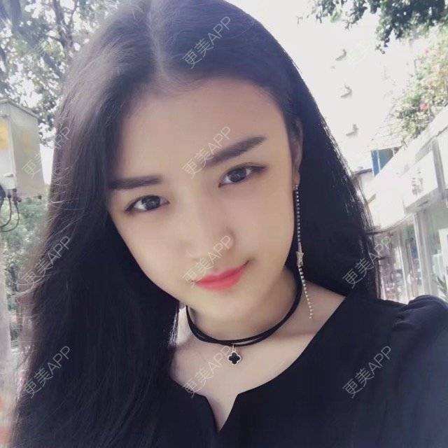 更美 - 石头玛丽的自体脂肪丰苹果肌经验 | 视频日记 | 成都