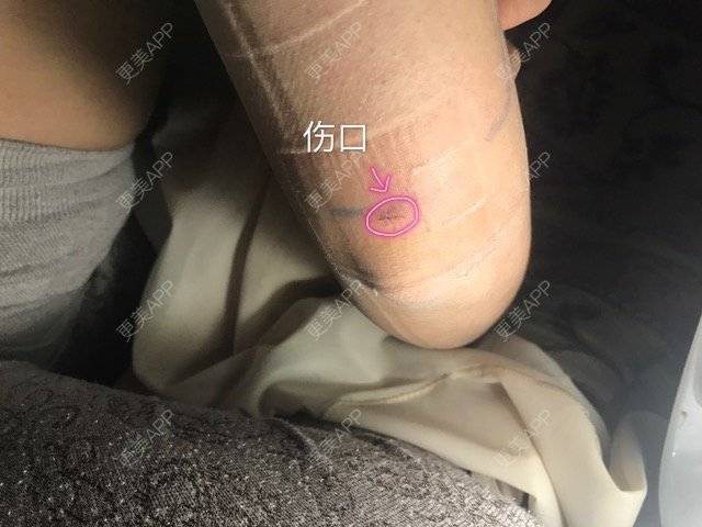 更美 - Joni小小板娘的射频溶脂瘦手臂经验 | 上海 | 射频溶脂瘦手臂