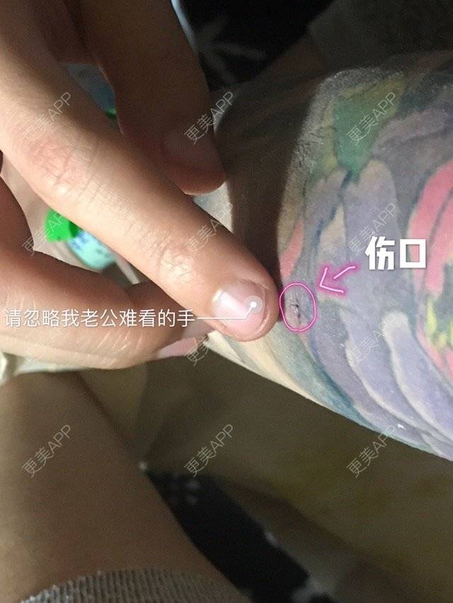 更美 - Joni小小板娘的射频溶脂瘦手臂经验 | 上海 | 射频溶脂瘦手臂
