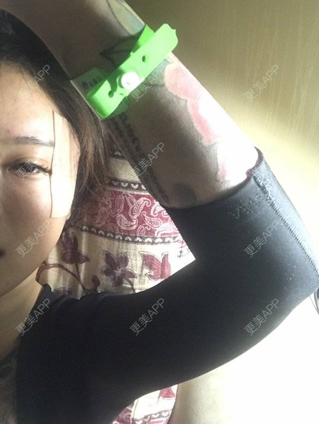 更美 - Joni小小板娘的射频溶脂瘦手臂经验 | 上海 | 射频溶脂瘦手臂