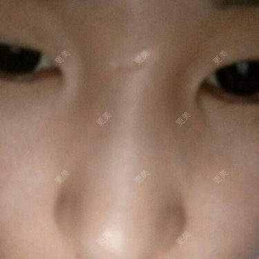 注射淡疤