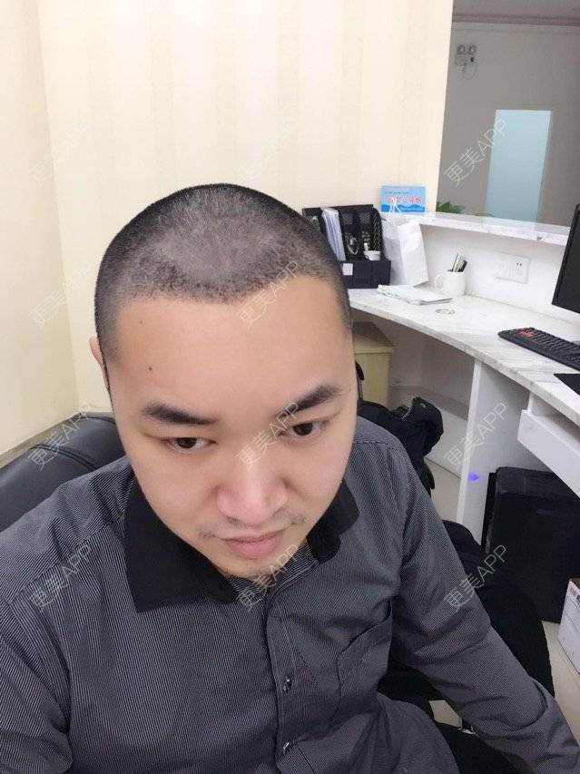 更美 - 本性难移的经验 | 种植毛发 | 移植发际线 | 武汉