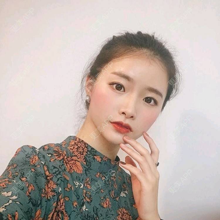 更美 - 车厘子音效的玻尿酸苹果肌经验 | 玻尿酸苹果肌 | 长沙