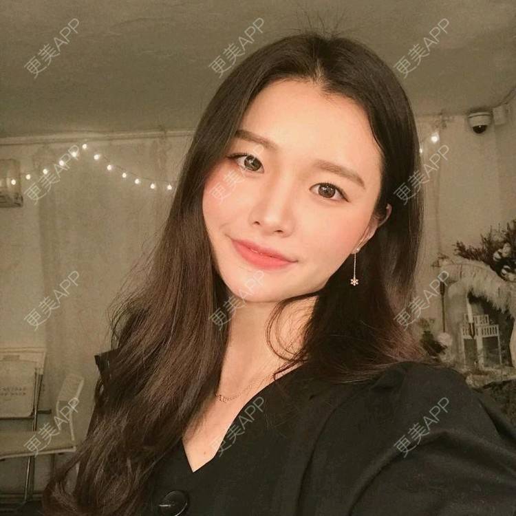 更美 - 车厘子音效的玻尿酸苹果肌经验 | 玻尿酸苹果肌 | 长沙