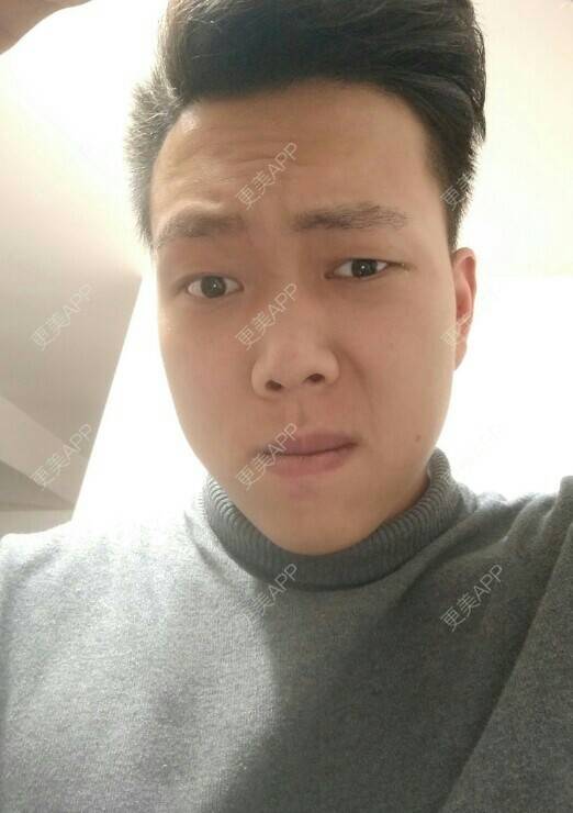 更美 - 哼唧哼唧唧的植眉经验 | 成都 | 植眉毛 | 植眉 | 毛发管理