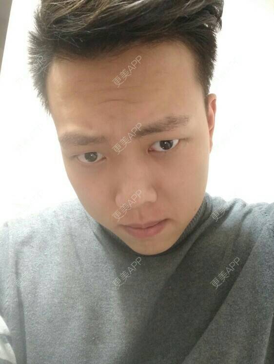 更美 - 哼唧哼唧唧的植眉经验 | 成都 | 植眉毛 | 植眉 | 毛发管理
