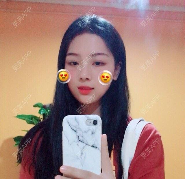 更美 - 原来是美凡的驼峰鼻矫正经验 | 双眼皮 | 鼻部整形 | 驼峰鼻矫正 | 瘦脸针下巴 | 首尔