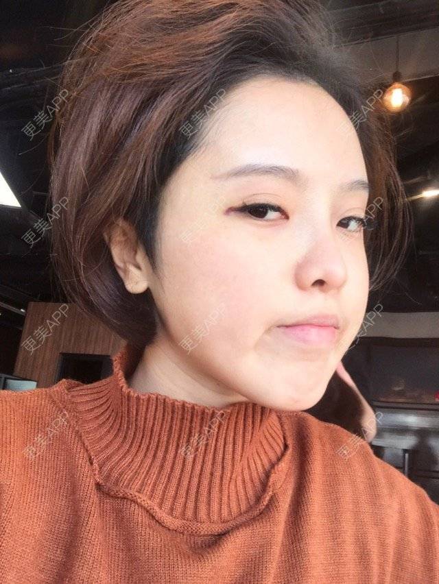 更美 - Joni小小板娘的射频溶脂瘦手臂经验 | 上海 | 射频溶脂瘦手臂
