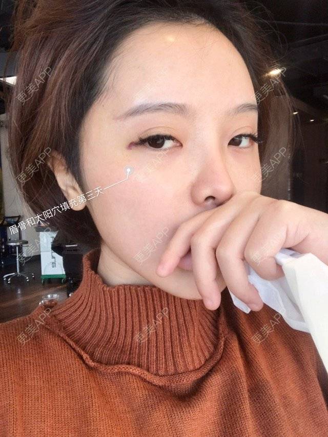 更美 - Joni小小板娘的射频溶脂瘦手臂经验 | 上海 | 射频溶脂瘦手臂