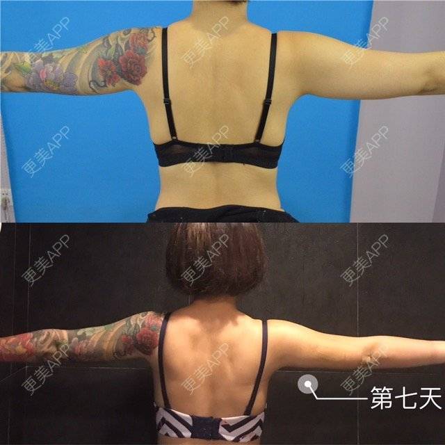 更美 - Joni小小板娘的射频溶脂瘦手臂经验 | 上海 | 射频溶脂瘦手臂