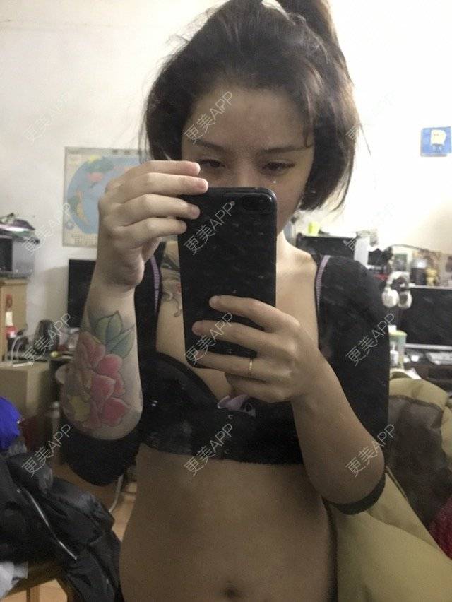 更美 - Joni小小板娘的射频溶脂瘦手臂经验 | 上海 | 射频溶脂瘦手臂