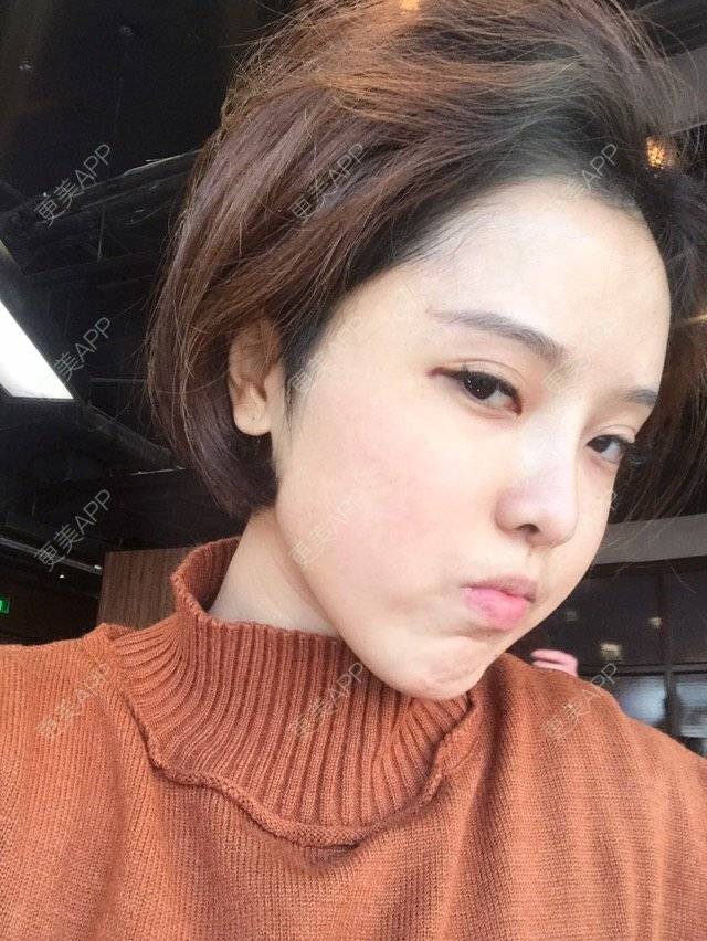 更美 - Joni小小板娘的射频溶脂瘦手臂经验 | 上海 | 射频溶脂瘦手臂