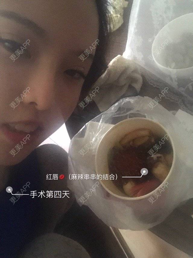 更美 - Joni小小板娘的射频溶脂瘦手臂经验 | 上海 | 射频溶脂瘦手臂