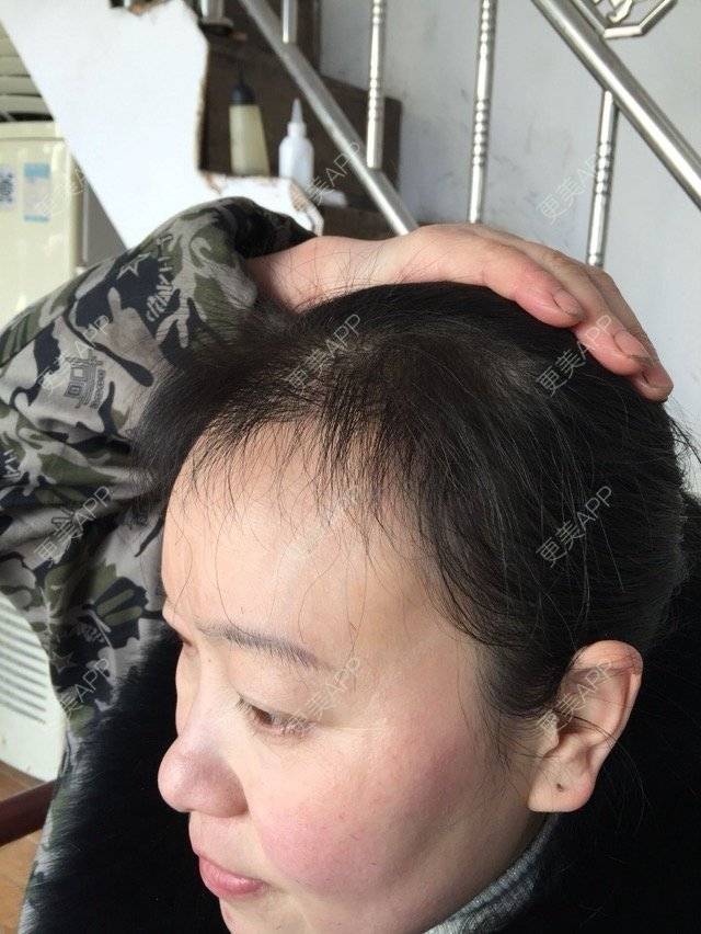 更美 - 梦里笑如花的植发际线经验 | 移植发际线 | 头发种植 | 植发际线 | 武汉