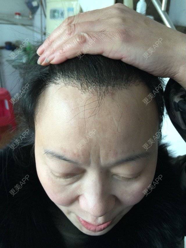 更美 - 梦里笑如花的植发际线经验 | 移植发际线 | 头发种植 | 植发际线 | 武汉