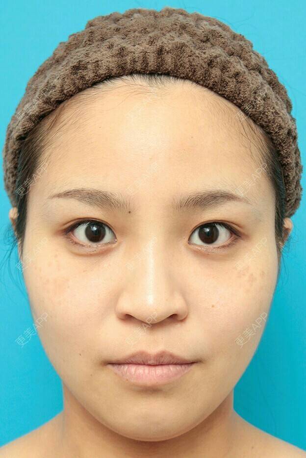 更美 - 更美用户waJcEiihM5的自体脂肪隆鼻经验 | 广州 | 自体脂肪隆鼻