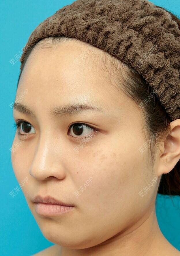 更美 - 更美用户waJcEiihM5的自体脂肪隆鼻经验 | 广州 | 自体脂肪隆鼻