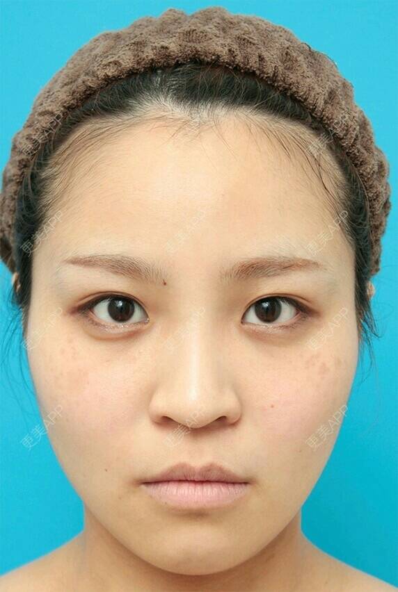 更美 - 更美用户waJcEiihM5的自体脂肪隆鼻经验 | 广州 | 自体脂肪隆鼻