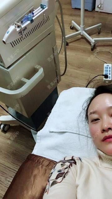 更美 - 谁说风轻云静的激光淡化红血丝经验 | 激光淡化红血丝 | 成都