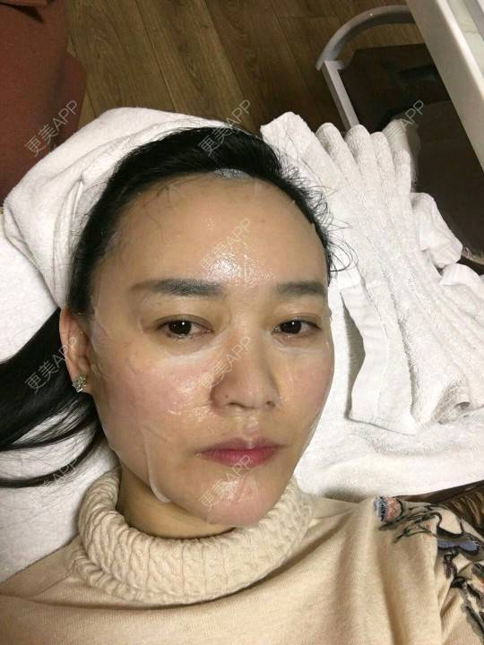 更美 - 谁说风轻云静的激光淡化红血丝经验 | 激光淡化红血丝 | 成都