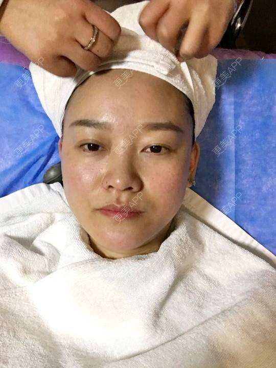 更美 - 谁说风轻云静的激光淡化红血丝经验 | 激光淡化红血丝 | 成都