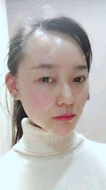 更美 - 谁说风轻云静的激光淡化红血丝经验 | 激光淡化红血丝 | 成都