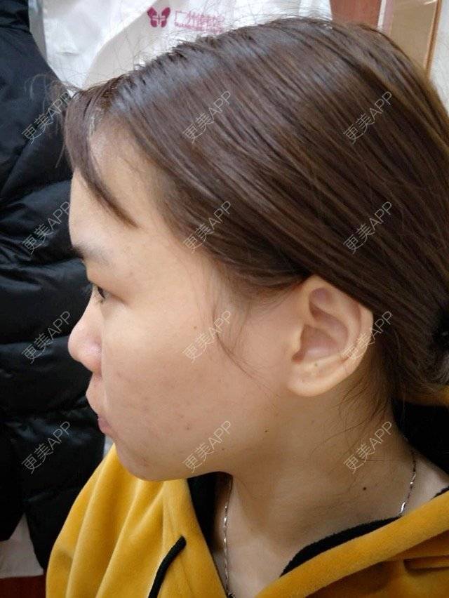 更美 - 苹果仔🌈的果酸焕肤经验 | 水杨酸 | 消炎祛痘 | 果酸焕肤 | 宣城