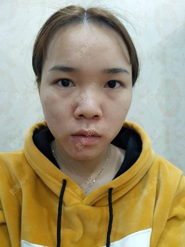 更美 - 苹果仔🌈的果酸焕肤经验 | 水杨酸 | 消炎祛痘 | 果酸焕肤 | 宣城