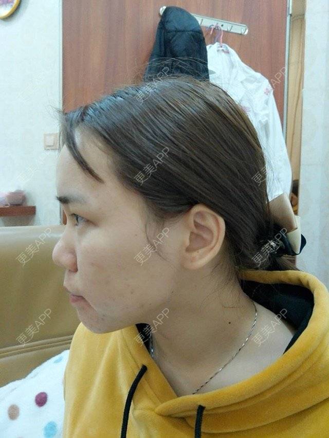 更美 - 苹果仔🌈的果酸焕肤经验 | 水杨酸 | 消炎祛痘 | 果酸焕肤 | 宣城
