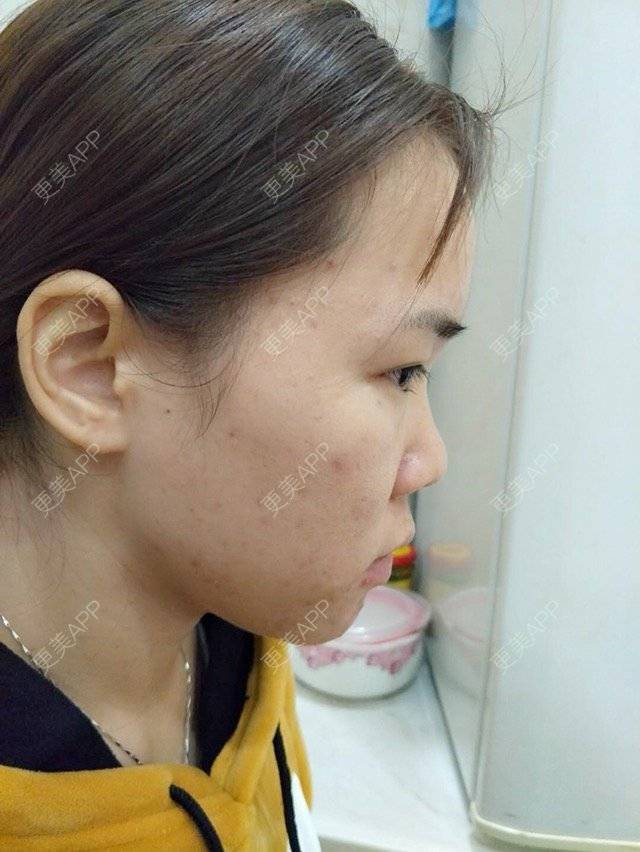 更美 - 苹果仔🌈的果酸焕肤经验 | 水杨酸 | 消炎祛痘 | 果酸焕肤 | 宣城