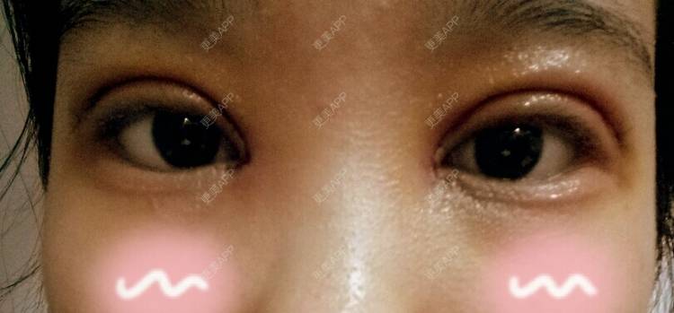 更美 - YYI_YEE的全切双眼皮经验 | 潍坊 | 全切双眼皮