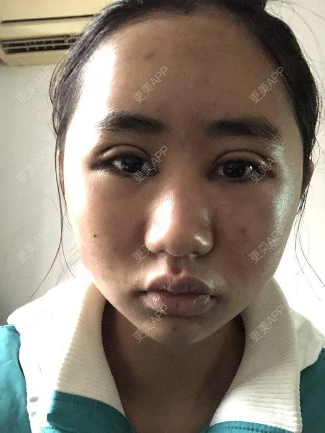 更美 - 苏州工业园区颜术医疗美容诊所的全切双眼皮经验 | 全切双眼皮 | 芜湖
