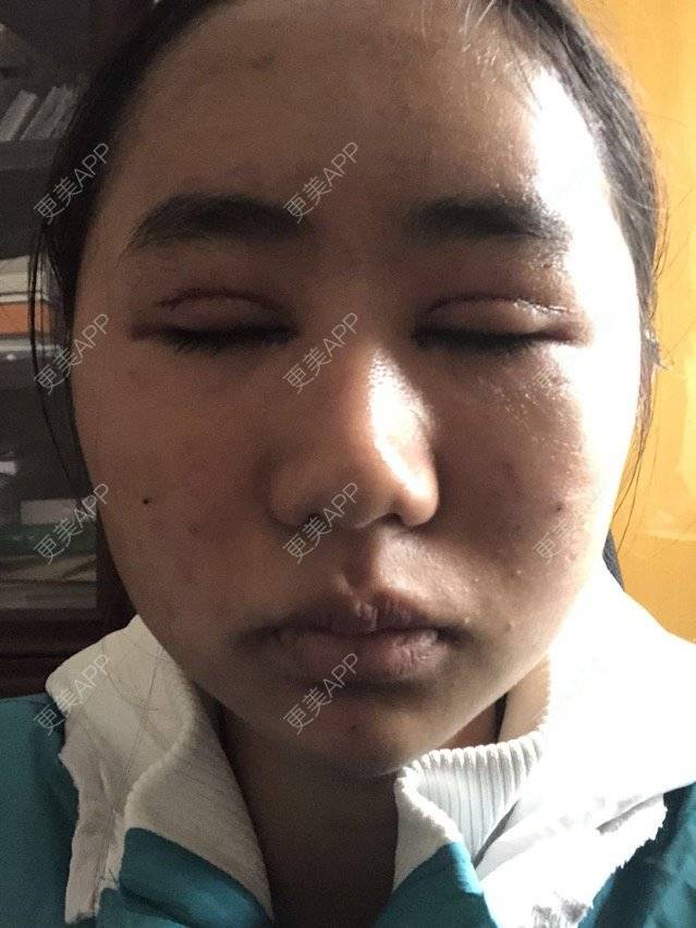 更美 - 苏州工业园区颜术医疗美容诊所的全切双眼皮经验 | 全切双眼皮 | 芜湖