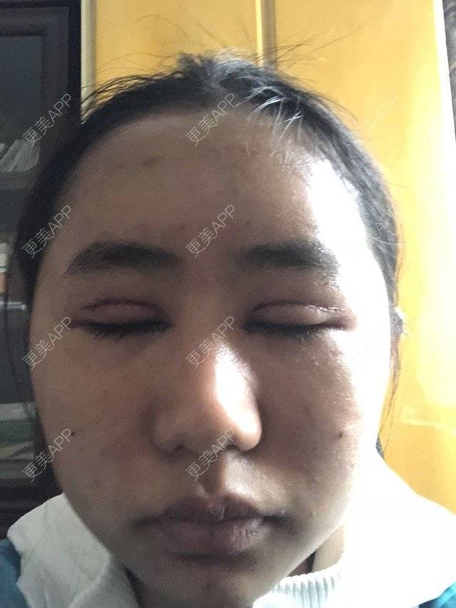更美 - 苏州工业园区颜术医疗美容诊所的全切双眼皮经验 | 全切双眼皮 | 芜湖