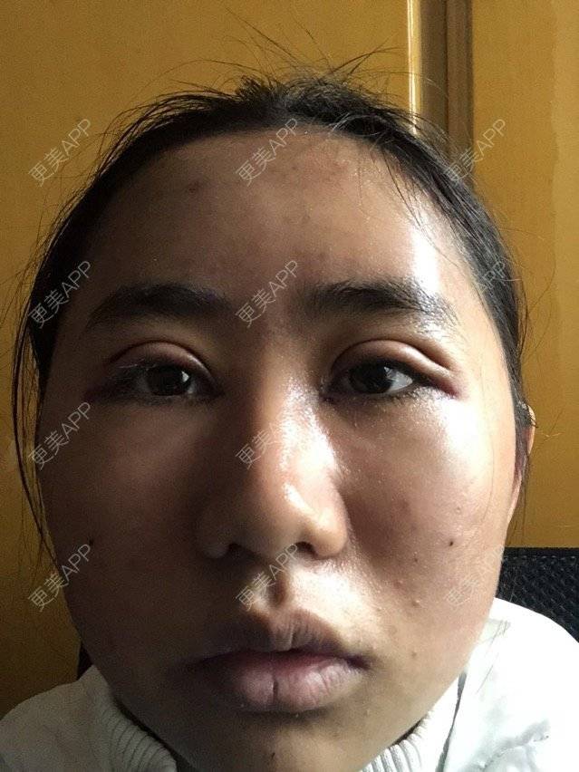 更美 - 苏州工业园区颜术医疗美容诊所的全切双眼皮经验 | 全切双眼皮 | 芜湖