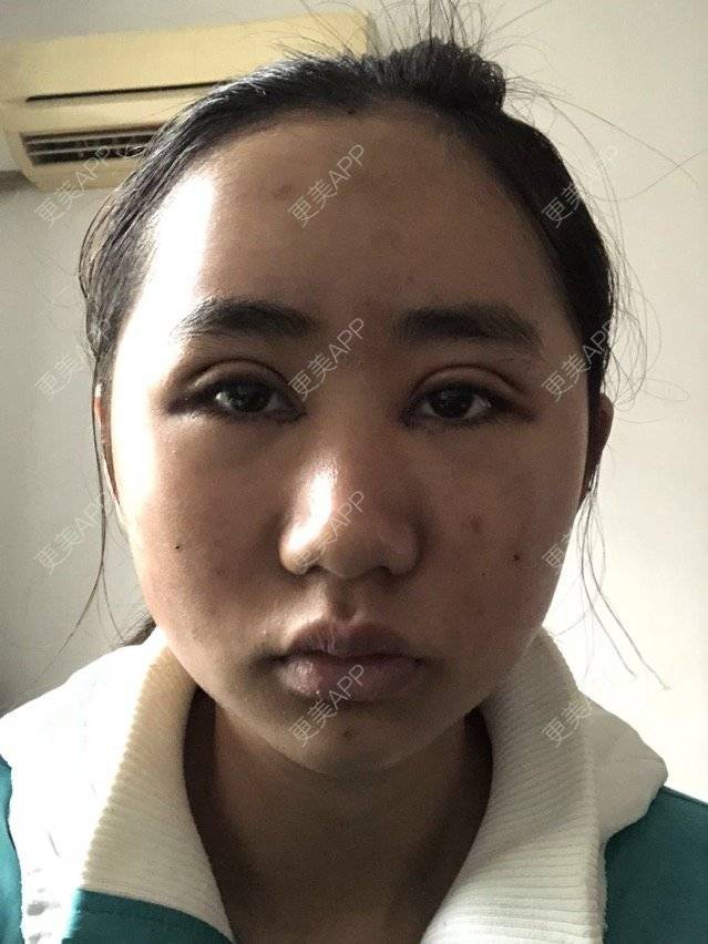 更美 - 苏州工业园区颜术医疗美容诊所的全切双眼皮经验 | 全切双眼皮 | 芜湖