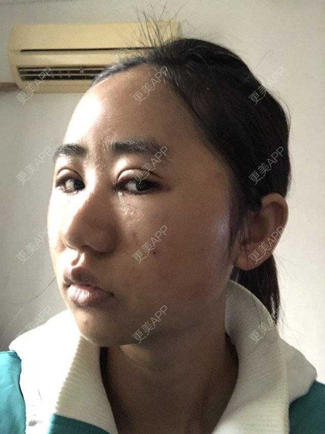 更美 - 苏州工业园区颜术医疗美容诊所的全切双眼皮经验 | 全切双眼皮 | 芜湖