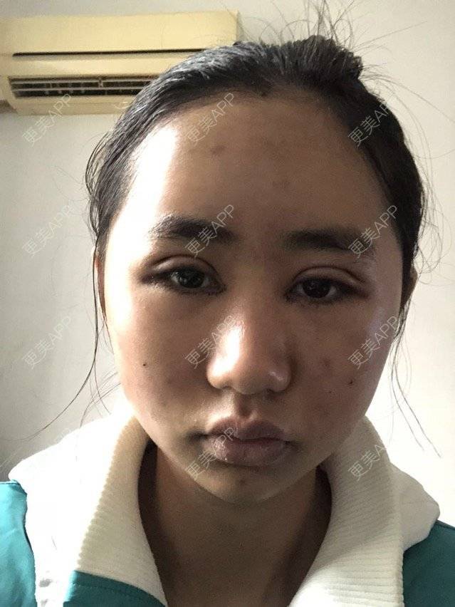 更美 - 苏州工业园区颜术医疗美容诊所的全切双眼皮经验 | 全切双眼皮 | 芜湖
