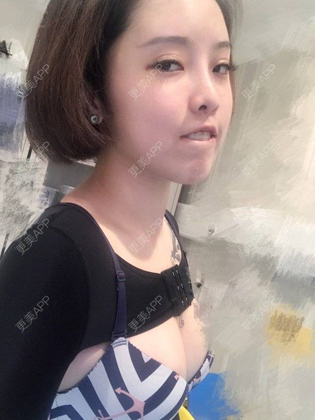 更美 - Joni小小板娘的射频溶脂瘦手臂经验 | 上海 | 视频日记 | 射频溶脂瘦手臂