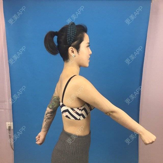 更美 - Joni小小板娘的射频溶脂瘦手臂经验 | 上海 | 视频日记 | 射频溶脂瘦手臂