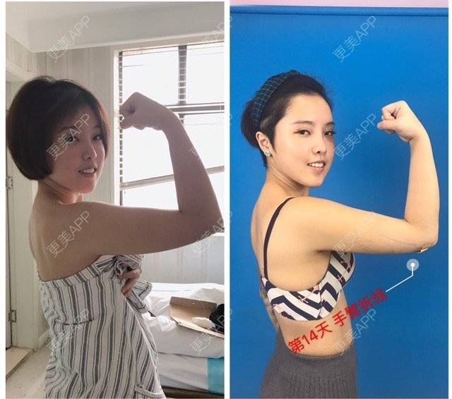 更美 - Joni小小板娘的射频溶脂瘦手臂经验 | 上海 | 视频日记 | 射频溶脂瘦手臂