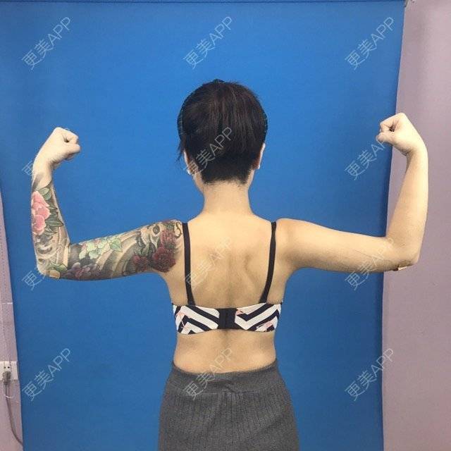 更美 - Joni小小板娘的射频溶脂瘦手臂经验 | 上海 | 视频日记 | 射频溶脂瘦手臂