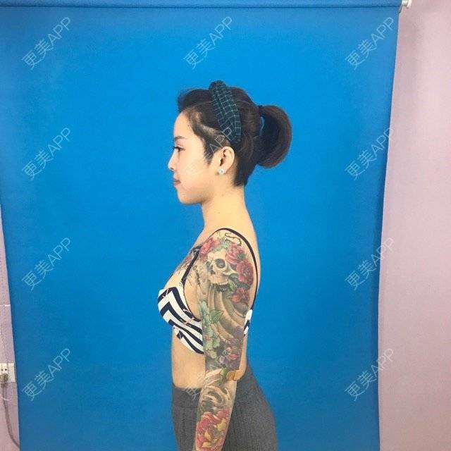 更美 - Joni小小板娘的射频溶脂瘦手臂经验 | 上海 | 视频日记 | 射频溶脂瘦手臂