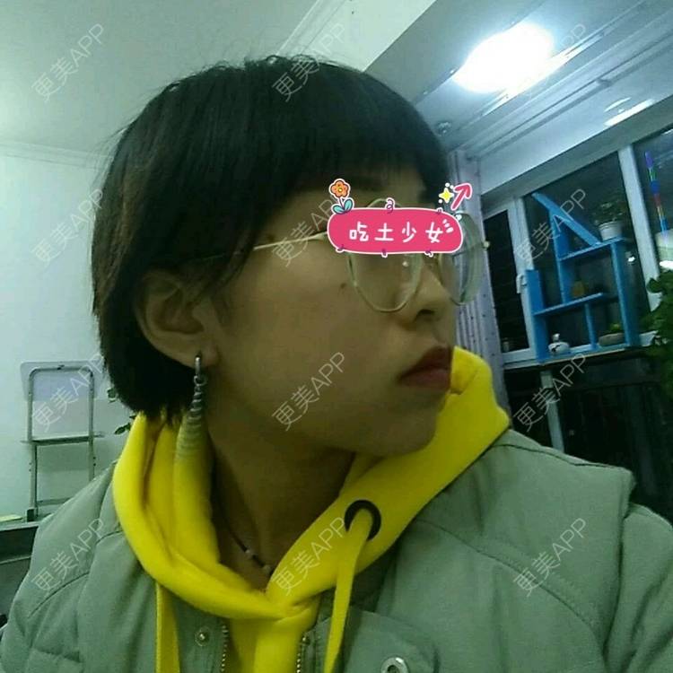 更美 - *卡姆勒的玻尿酸下巴经验 | 鞍山 | 玻尿酸下巴