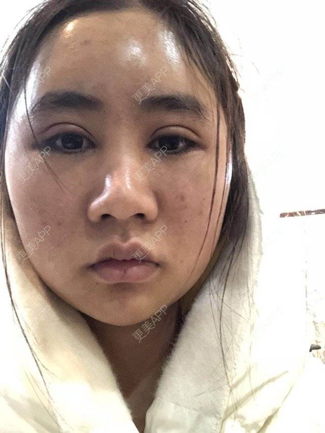 更美 - 苏州工业园区颜术医疗美容诊所的全切双眼皮经验 | 芜湖 | 全切双眼皮