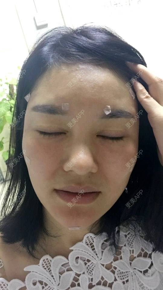 更美 - 可爱的绘梨衣的玻尿酸太阳穴经验 | 玻尿酸太阳穴 | 深圳