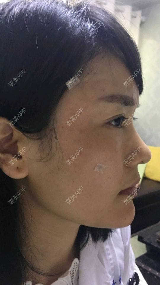 更美 - 可爱的绘梨衣的玻尿酸太阳穴经验 | 玻尿酸太阳穴 | 深圳