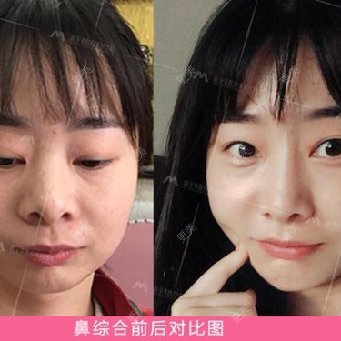 鼻部整形